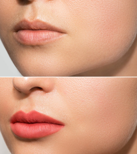 before and after comparison of the lips of a woman