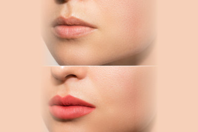 before and after comparison of the lips of a woman
